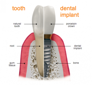 Implantat tand